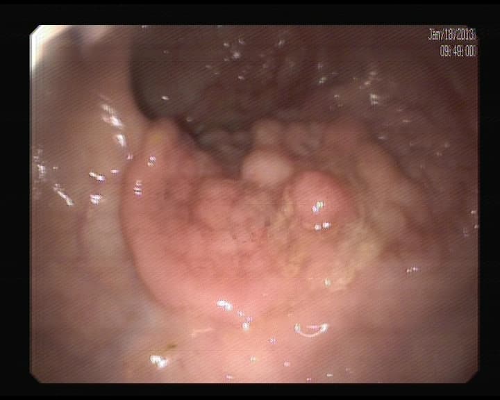 Neoplasia gástrica.