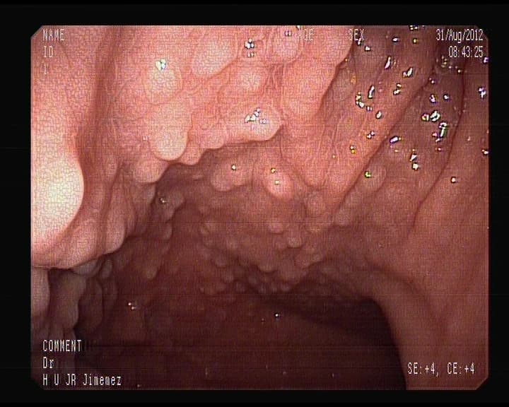 Pólipos Hiperplásicos Gastricos.