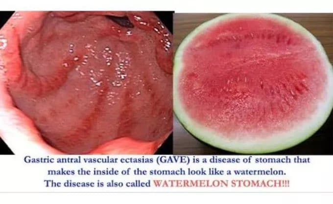 Alteración Vascular en estómago- Angiodisplasia.