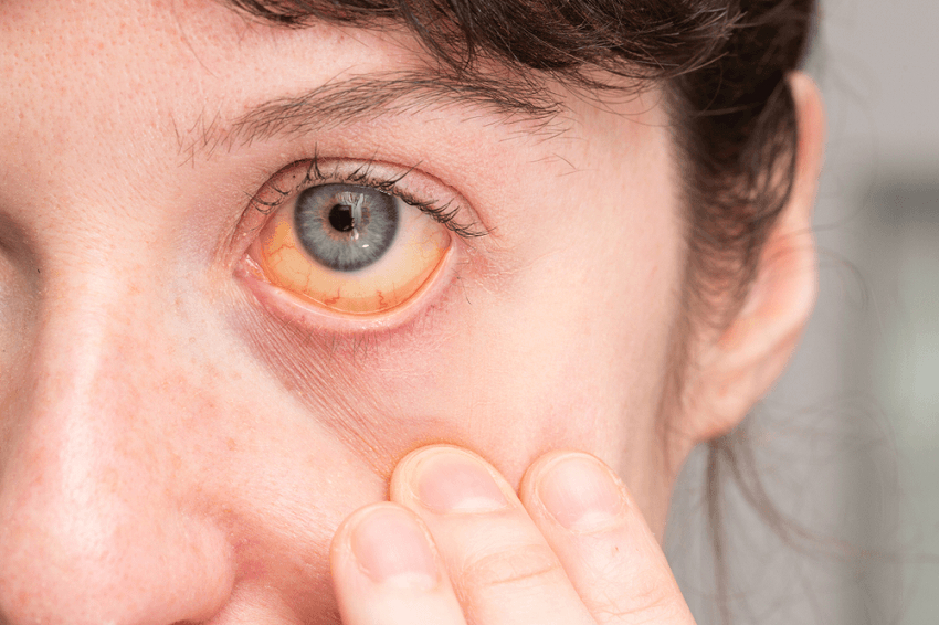 SINDROME DE GILBERT.  Información para Pacientes.