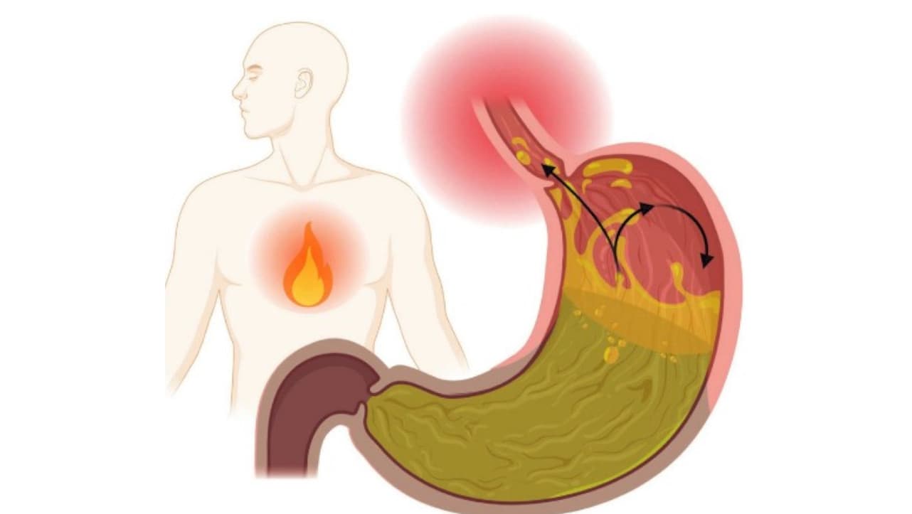 REFLUJO GASTROESOFÁGICO.