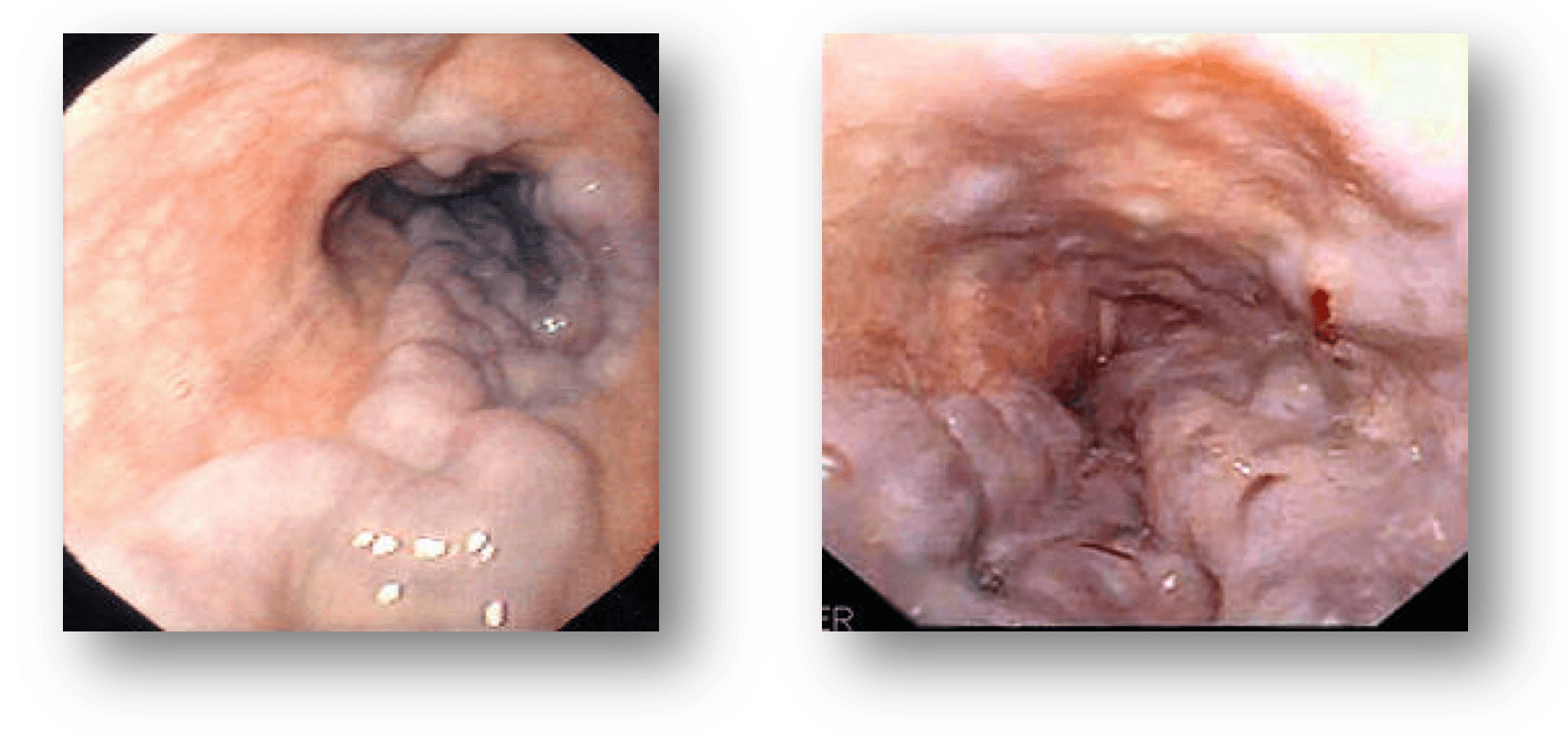 ECHAR EL HÍGADO POR LA BOCA.- Hemorragia Digestiva por Varices esofágicas. (Información para Pacientes).
