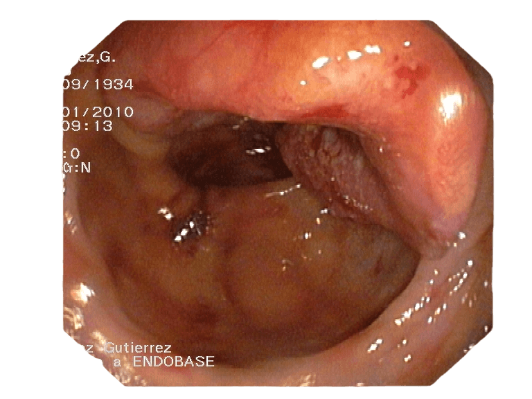 CÁNCER DE COLON. (Información Para pacientes)