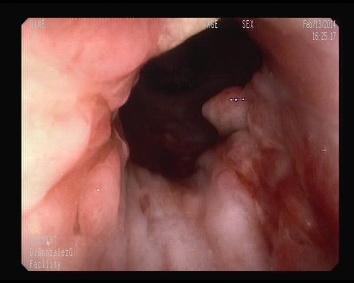 Enfermedad de Crohn afectando ano.