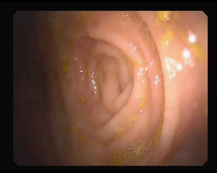 Otra cara de un orificio apendicular normal