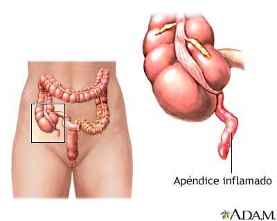 APENDICITIS AGUDA. (Información para pacientes).