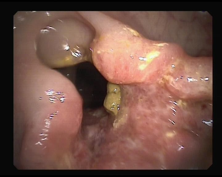 Cáncer infiltrativo estenosante en colon izquierdo