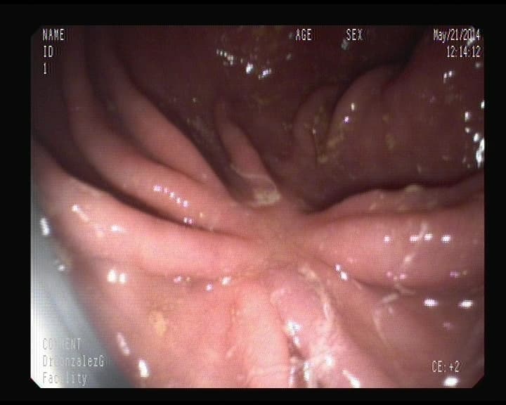 Cicatriz de Úlcera grande en estómago