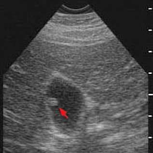 Colesterolosis