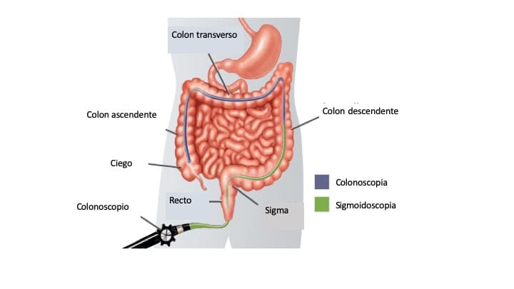 COLONOSCOPIA.