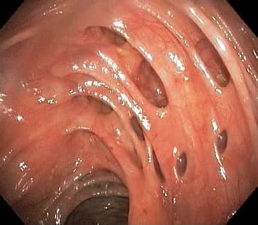 DIVERTICULOSIS-ENFERMEDAD DIVERTICULAR. (Información para Pacientes).