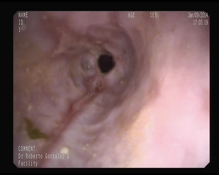 Esofagitis Péptica.-