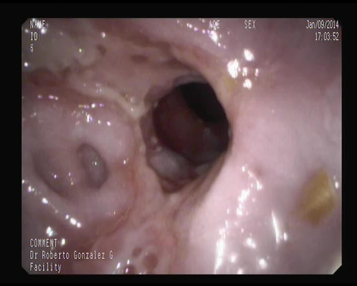 Esofagitis péptica complicada.