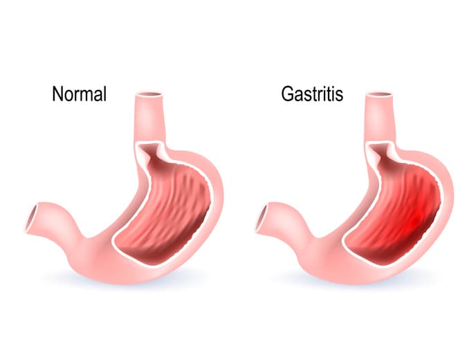 GASTRITIS . Información para Pacientes.