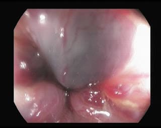 HEMORROIDES. SANGRADO