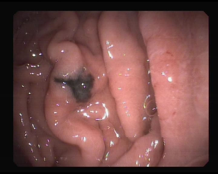 Implante negruzco en estómago.