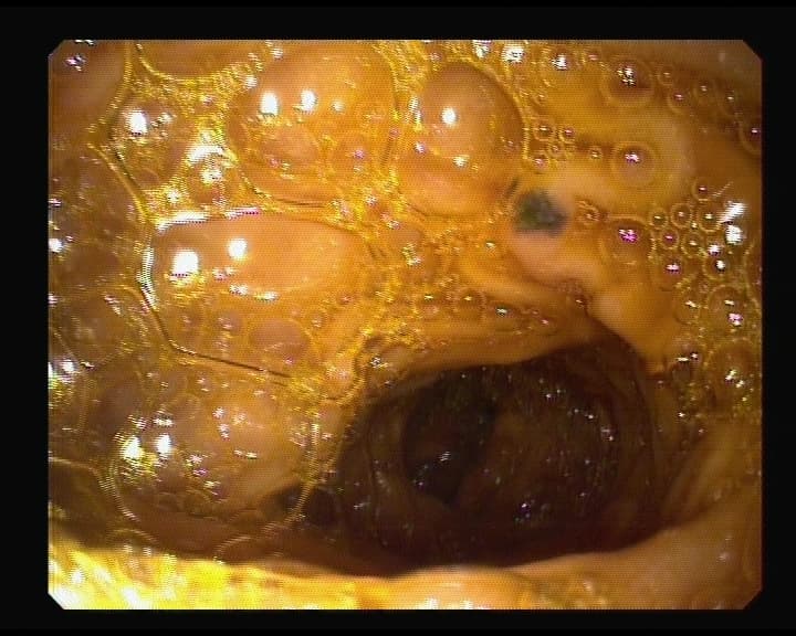 Puntos negros en Duodeno