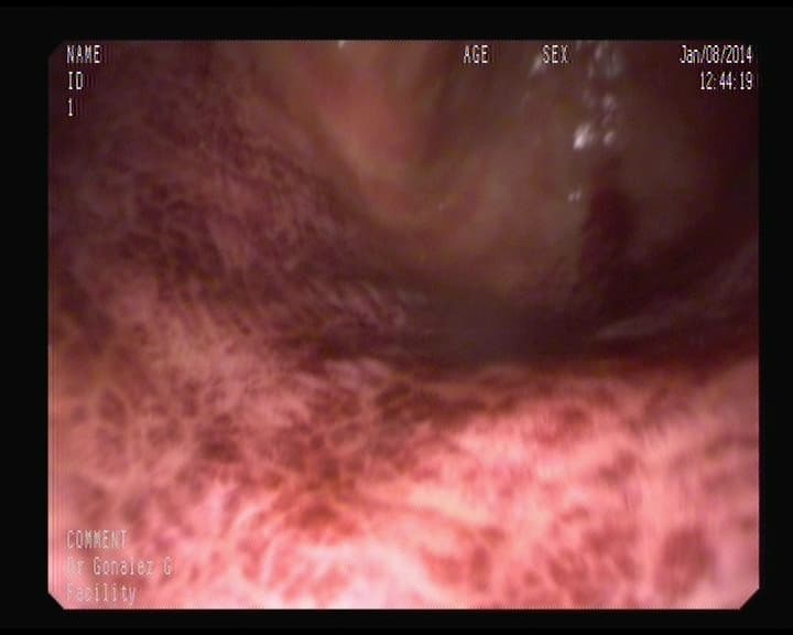 Estómago por ingesta de Caústicos