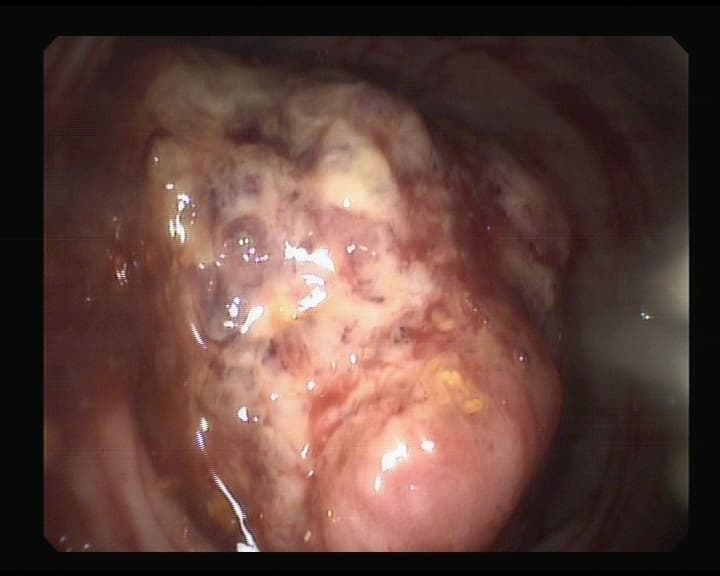 Cáncer de Recto que obstruye la luz, ulcerado y sangrante.