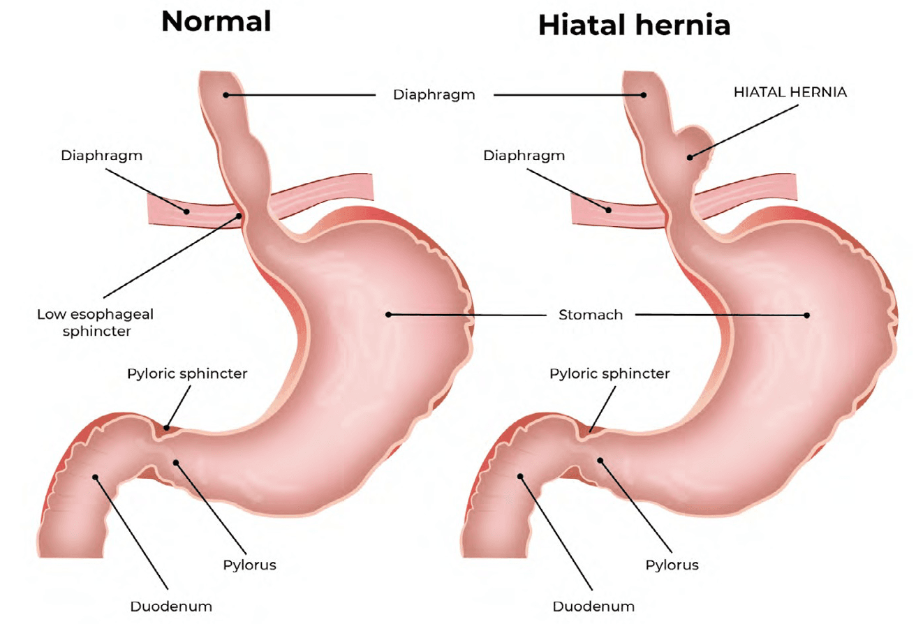 LA HERNIA DE HIATO. (Información Para Pacientes)