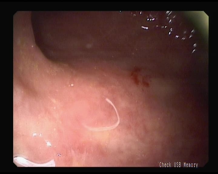 Parasito Ascaris Lumbricoide pillado en Colonoscopia.