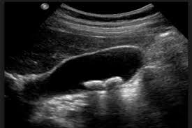 PIEDRAS EN LA VESÍCULA-COLELITIASIS. II- (Información para pacientes).