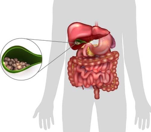 PIEDRAS EN LA VESÍCULA-COLELITIASIS. (Información para pacientes).