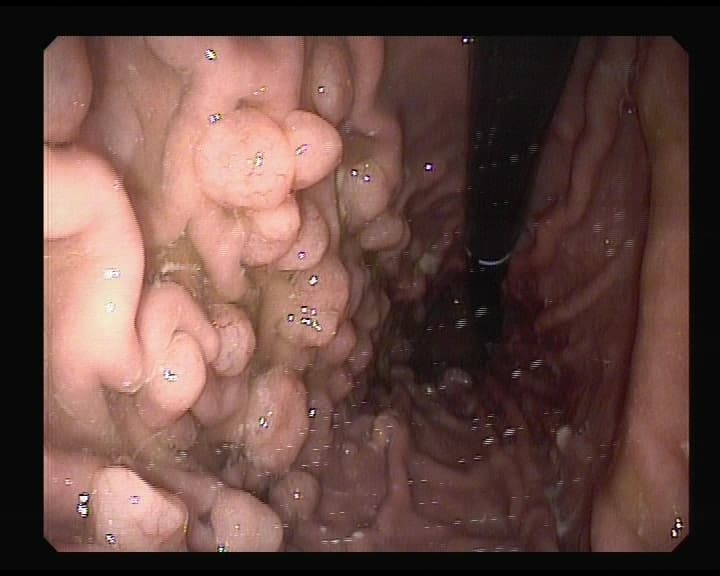 Pólipos en Estómago