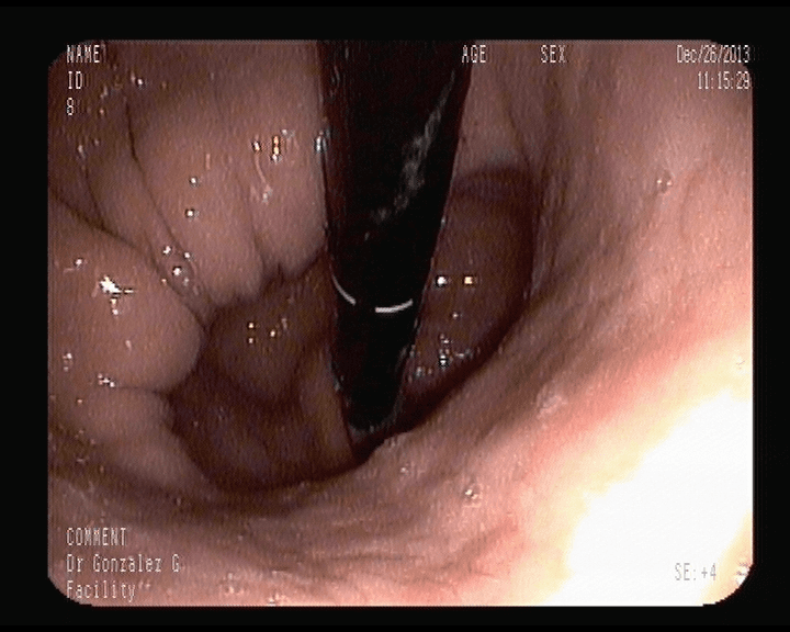 Hernia de Hiato. -Por deslizamiento-.