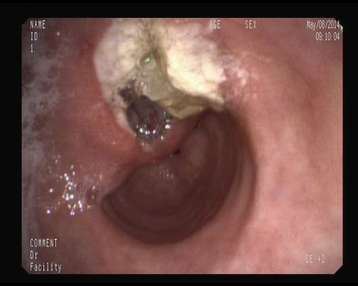 Úlcera Gástrica Benigna que había sangrado.