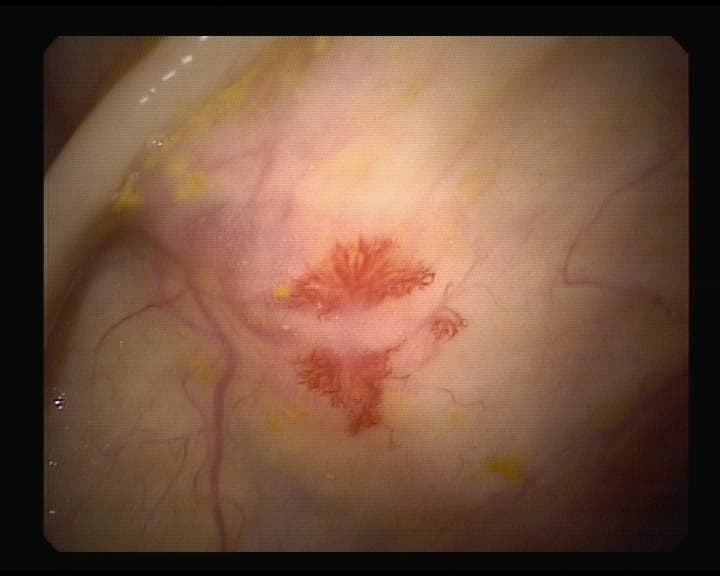 Angiodisplasia en zona Cecal