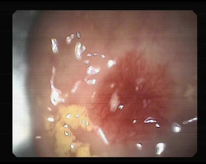 Angiodisplasia en colon.