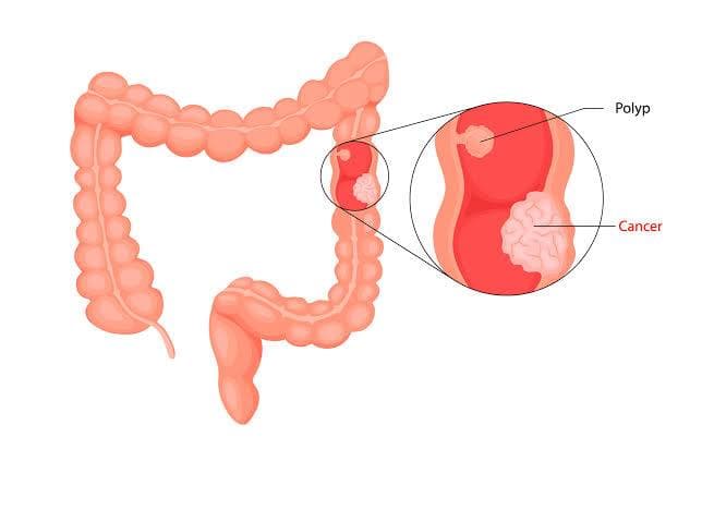 Oiga, Oiga...Colonoscopia- Cáncer de Colon. (Información Para Pacientes)