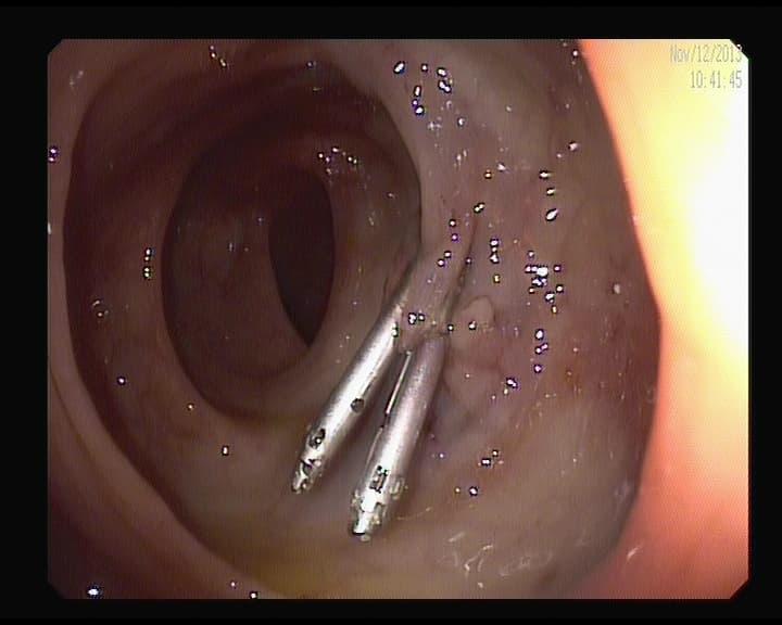 2clips Metálicos en colon.