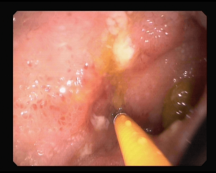 Afectación. de la Enfermedad de Crohn en intestino delgado.