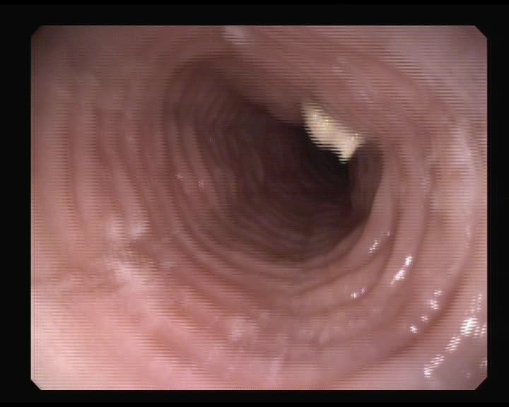 Esofagitis Eosinófilica