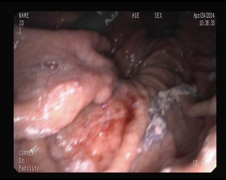 Gran Hernia de hiato.