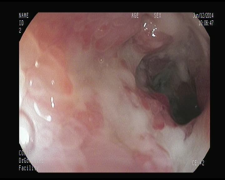 Crohn afectación del Ileon Terminal.