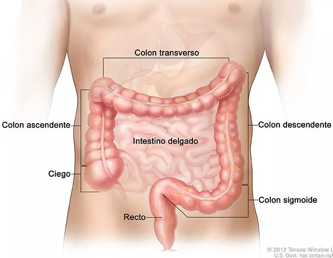 CÁNCER DE COLON- Prevención. ( Información para pacientes).