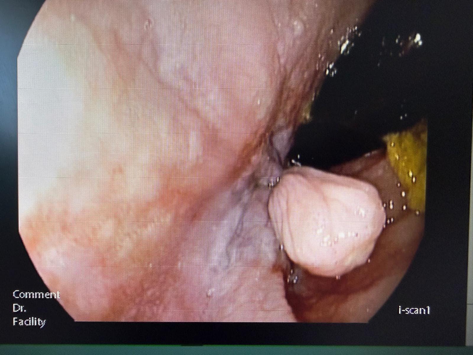 Polipo Fibroepitelial anal.