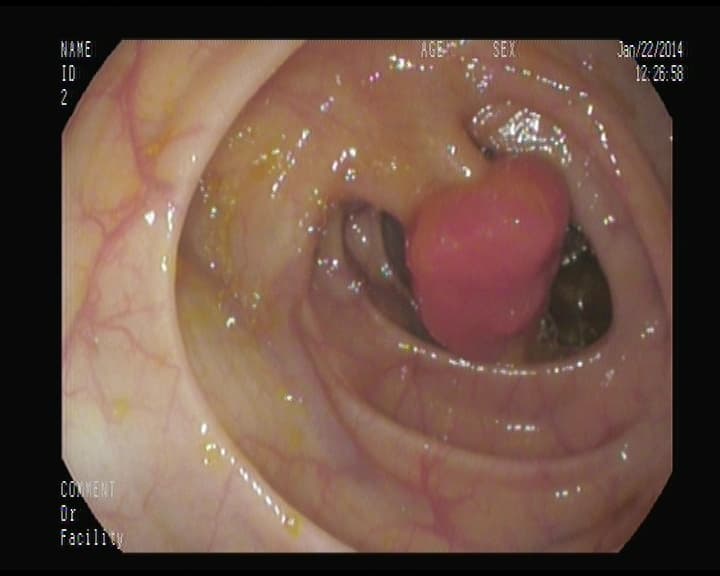 Pólipo adenomatoso, con pedículo ancho