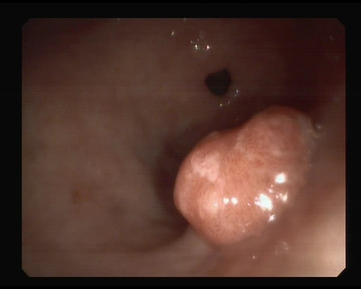 Pólipo gástrico Hiperplásico.