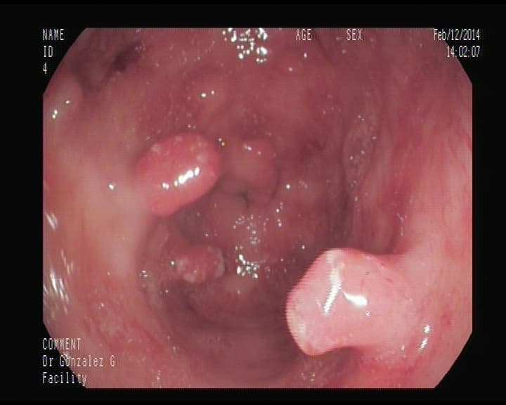 Pólipos gástricos múltiples en antro gástrico