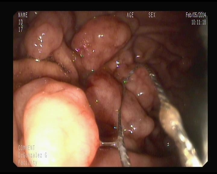 Pólipos múltiples Hiperplásicos en estómago.
