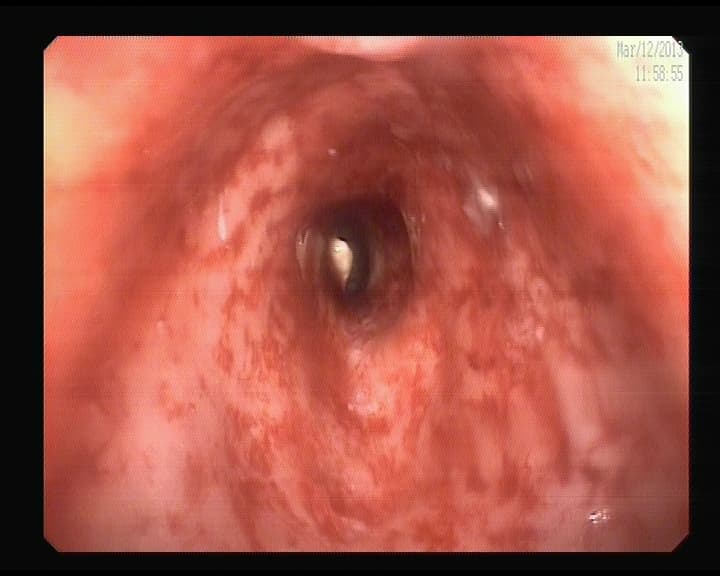 Proctitis Actínica.