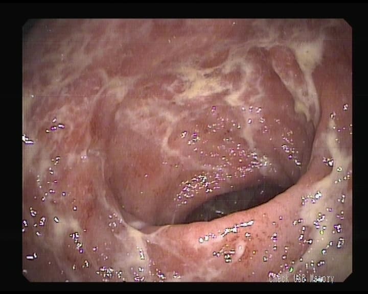 Proctitis Ulcerosa Inespecifica.