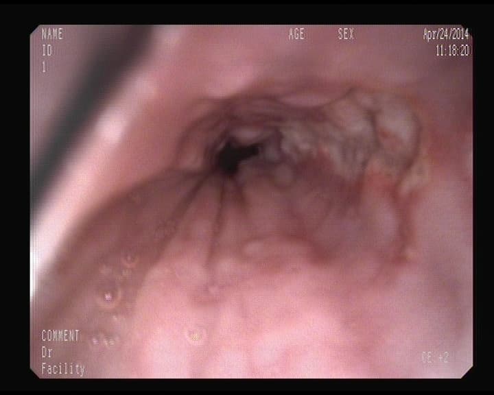 Úlcera en Esófago.