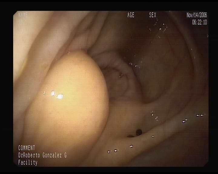 Lipoma en Colon.