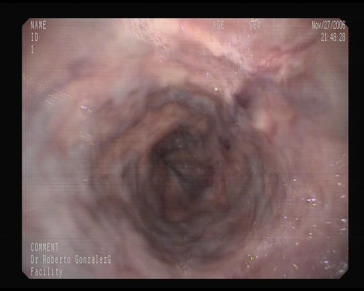 varices Esofágicas.