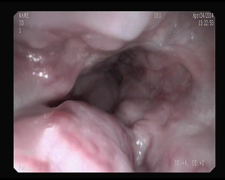 Varices Esofágicas grandes